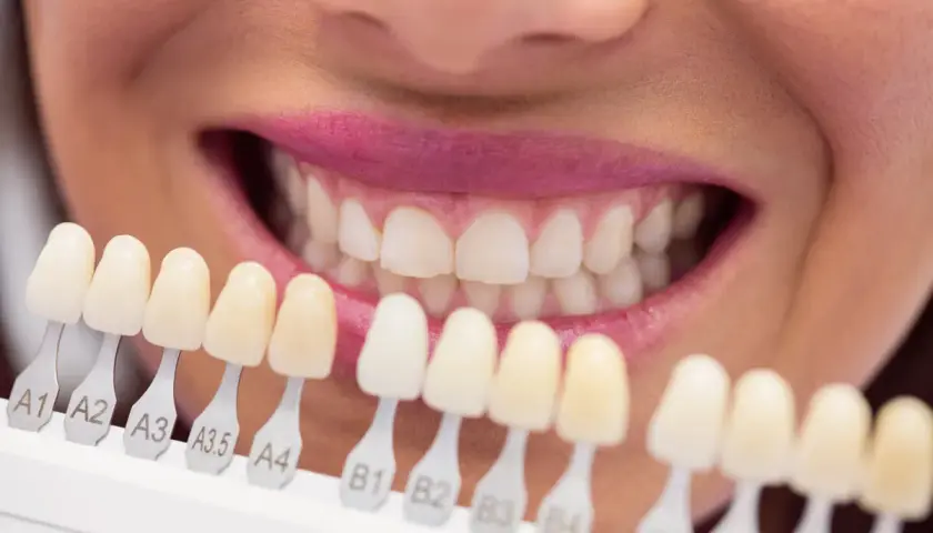 Wybielanie zębów u dentysty czy warto? Odkryj prawdę o skuteczności