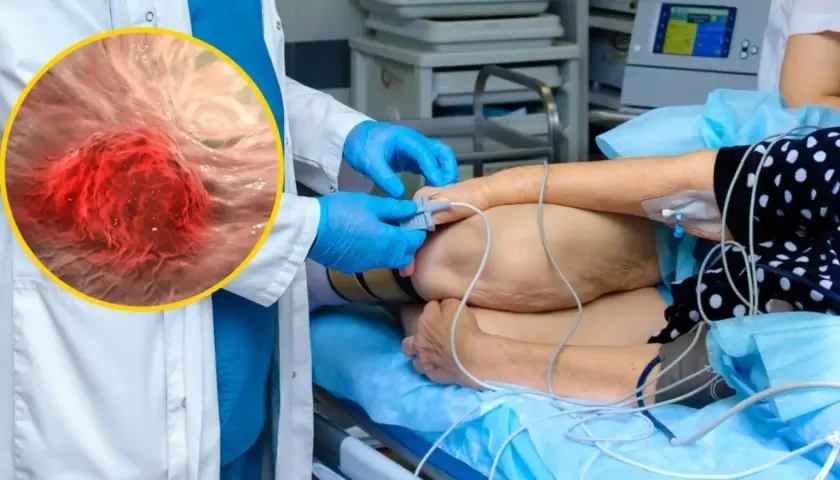 Lekarz w rękawiczkach przygotowuje pacjenta do zabiegu, podczas gdy powiększony obraz pokazuje komórki raka jelita grubego.