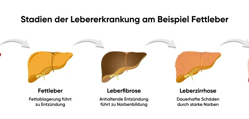 Stadien der Lebererkrankung: gesunde Leber, Fettleber (Fettablagerung führt zu Entzündung), Leberfibrose, Leberzirrhose und Leberkrebs. Was tun bei Fettleber?