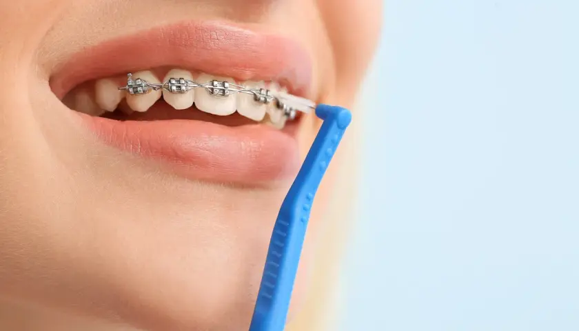 Pulizia dei denti con apparecchio, un passo fondamentale per prevenire l'alitosi. Rimedi efficaci per un sorriso smagliante.