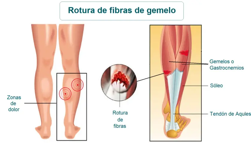 Ilustración médica de una rotura de fibras del gemelo, mostrando zonas de dolor y la anatomía muscular de la pantorrilla.