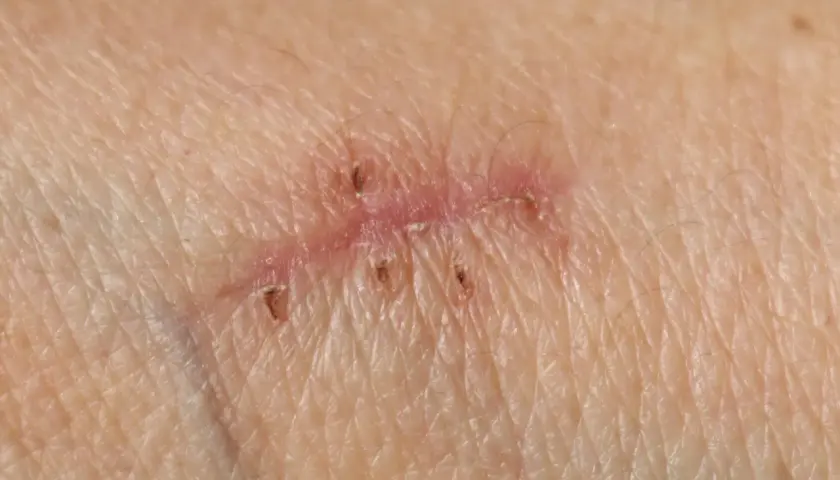 Piel con varias cicatrices, algunas con puntos de sutura visibles.