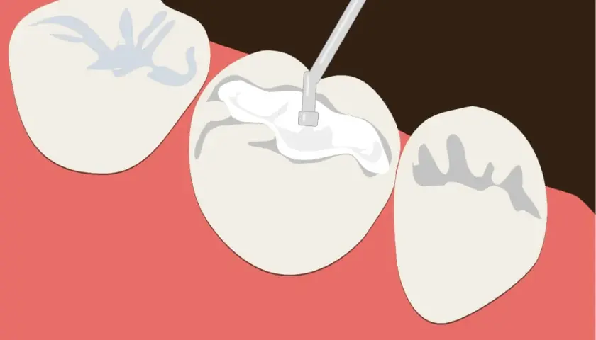 Aplicación de sellador dental para proteger contra caries y aliviar los dientes sensibles.