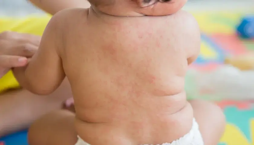 Baby's Rücken zeigt einen roten Ausschlag, möglicherweise nach 3 Tagen Fieber.
