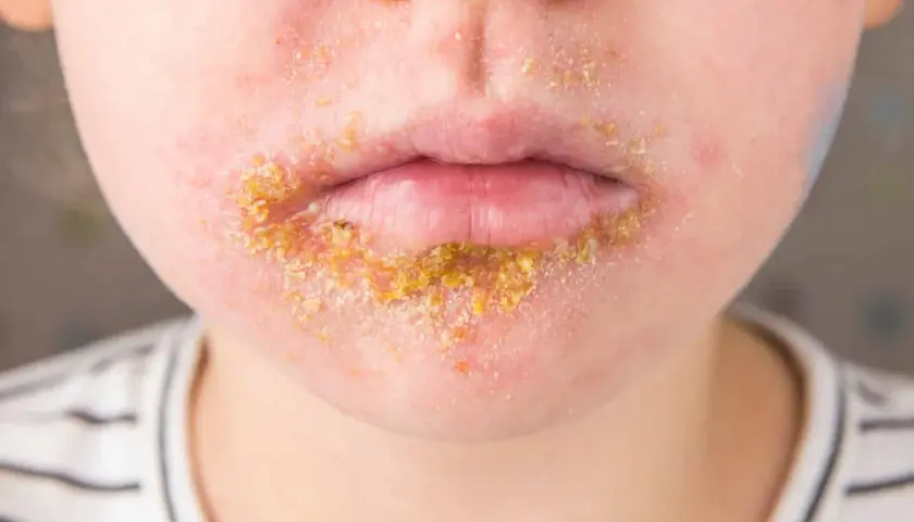 Bouche d'enfant atteinte d'impétigo, une infection cutanée qui peut causer du stress et de l'inconfort.