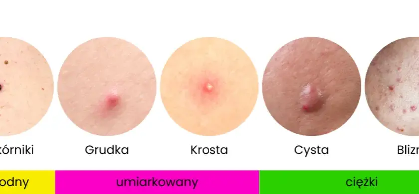 Jak pozbyć się pryszczy? Kompleksowy przewodnik po leczeniu