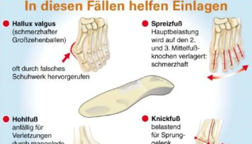 Weichpolstereinlagen helfen bei Hallux valgus, Spreizfuß, Hohlfuß und Knickfuß. Sie entlasten schmerzhafte Bereiche und beugen Verletzungen vor.