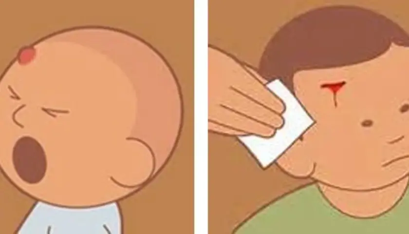 Bebé con chichón en la cabeza y niño con herida sangrante en la frente, mostrando un golpe en la cabeza niño.