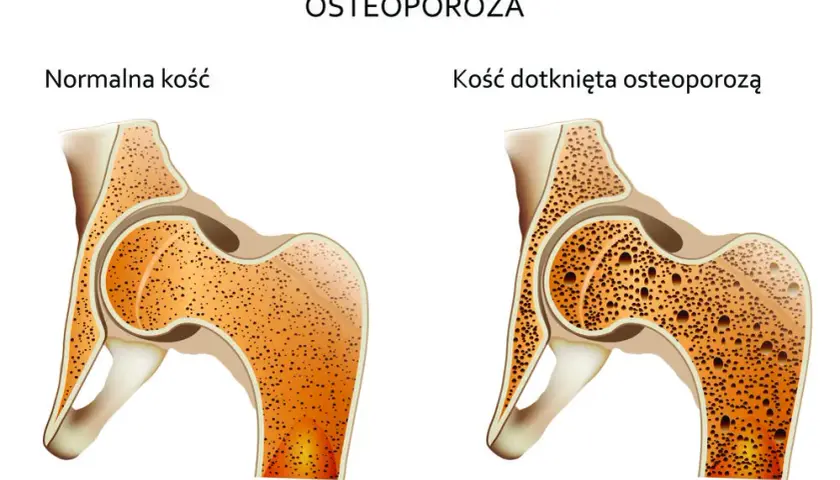 Osteoporoza przyczyny: Jak uniknąć utraty gęstości kości?