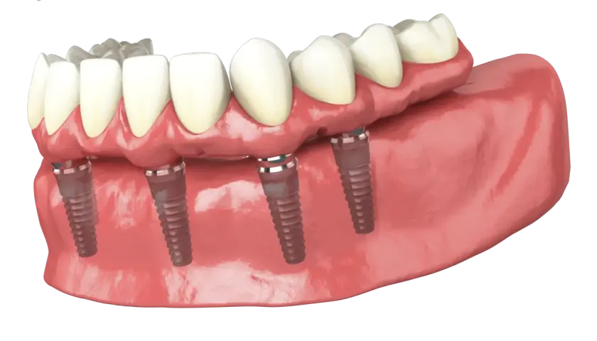 Dettaglio di una protesi dentale fissa su impianti, simile alla protesi Toronto, con denti bianchi e gengive rosa.