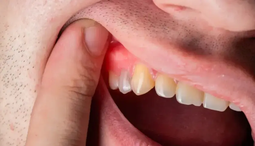 Ropa w dziąśle: Co robić? Szybka ulga i kiedy do dentysty