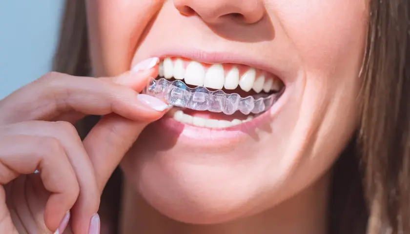Mujer se coloca un alineador transparente. Para mantenerlos impecables y evitar que el Invisalign amarillo, es clave una buena higiene.