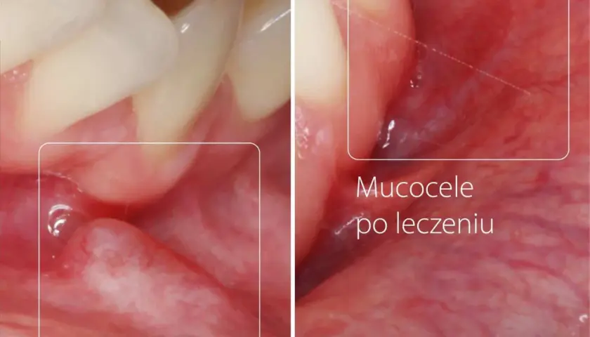 Przed i po leczeniu torbieli w jamie ustnej. Widoczne zmiany na błonie śluzowej.