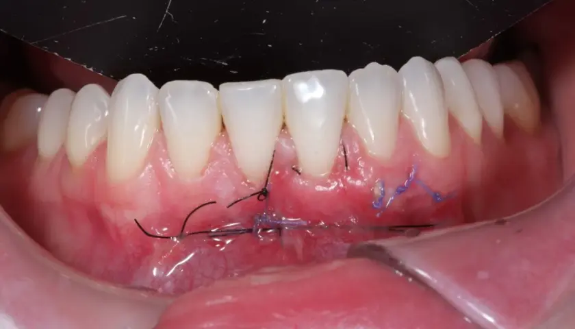 Boca con injerto libre de encía y suturas visibles. El tejido gingival se ve enrojecido y con puntos de sutura negros y morados.