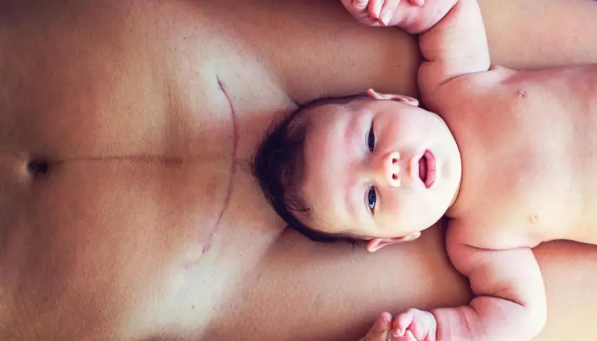 Ein Baby liegt auf dem Bauch seiner Mutter, deren Kaiserschnittnarbe sichtbar ist. Mögliche Symptome eines Geburtstraumas nach Kaiserschnitt können hier thematisiert werden.