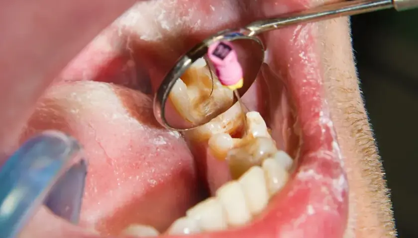 Zgorzel zęba w odbiciu lusterka dentystycznego. Widoczny jest ząb z ubytkiem i narzędzie stomatologiczne.