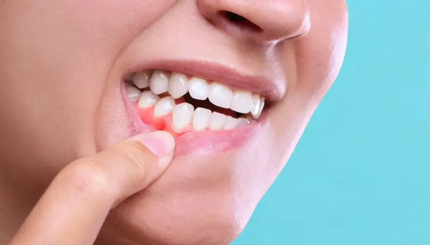 Dito un dito indica le gengive rosse e infiammate, un segno di problemi di dentizione o gengivite.
