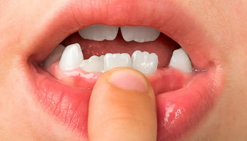 Boca de niño mostrando dientes temporales y un dedo que señala la encía, indicando la etapa en que a que edad se caen los colmillos.