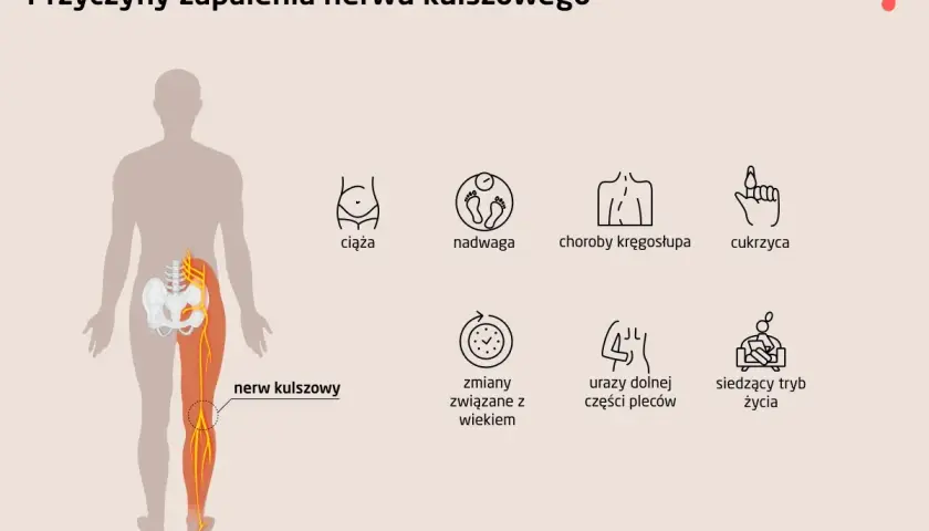 Ilustracja przedstawia przyczyny zapalenia nerwu kulszowego: ciążę, nadwagę, choroby kręgosłupa, cukrzycę, zmiany związane z wiekiem, urazy pleców i siedzący tryb życia.