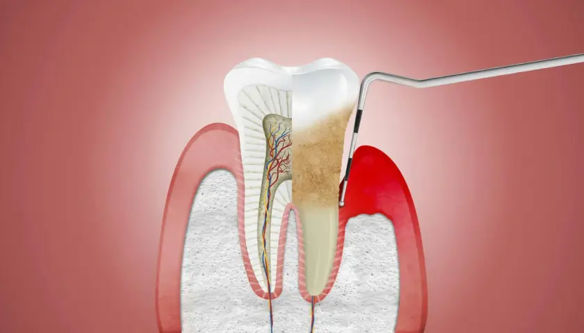 Przekrój zęba z widocznymi naczyniami krwionośnymi i nerwami. Narzędzie dentystyczne usuwa kamień nazębny, odsłaniając zdrowe przyzębie.