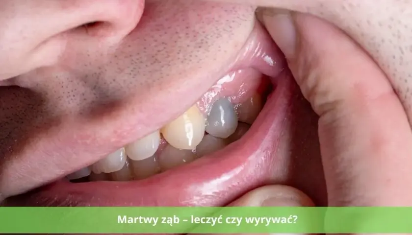 Martwy ząb: leczyć czy usunąć? Co wybrać? Koszty i zdrowie