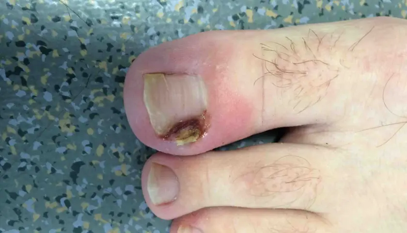 Gros plan d'un ongle incarné au pied, présentant une inflammation et une légère infection.