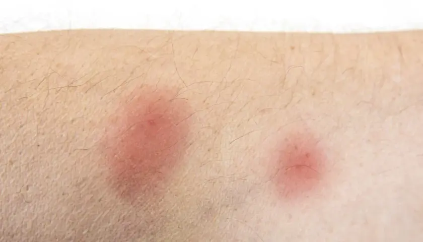 Hausstaubmilben Allergie Symptome: So erkennen Sie die Anzeichen