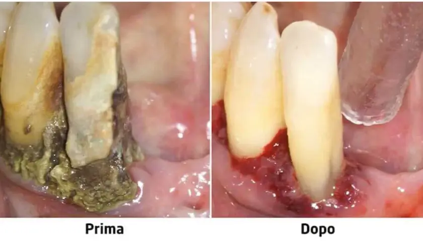 Prima e dopo: gengive infiammate e denti con tartaro, poi gengive sane. La piorrea può portare alla caduta dei denti.