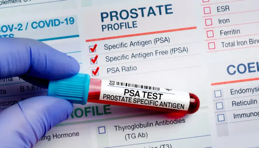Rękawiczka trzyma probówkę z krwią do badania PSA. Wyniki analizy PSA pomogą ocenić, jak obniżyć psa prostaty.