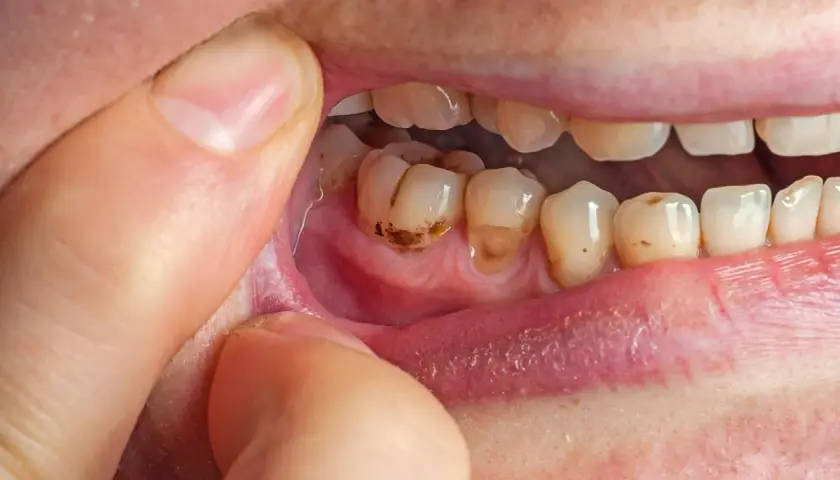 Denti cariati e gengive infiammate, possibili cause di alito cattivo dallo stomaco.