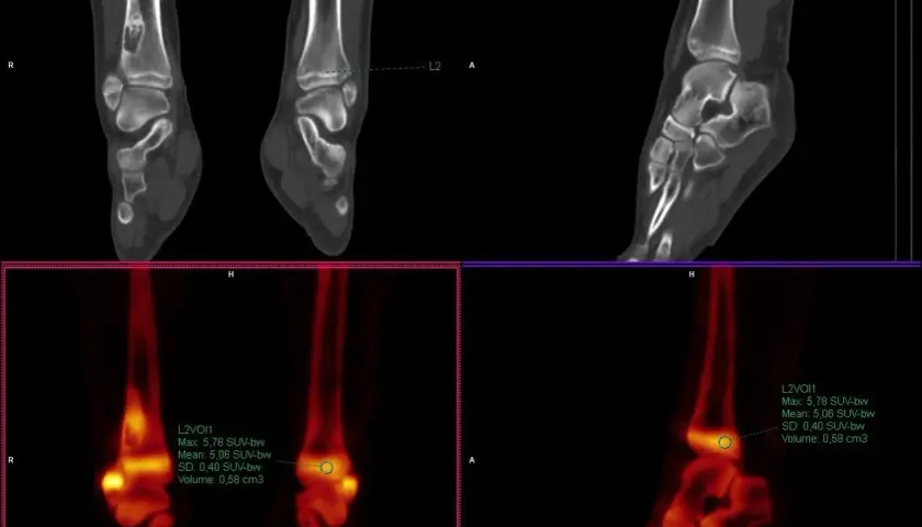 Co to jest SUV max i dlaczego jest kluczowy w diagnostyce?