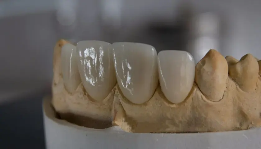Model szczęki z porcelanowymi koronami, gotowymi do odbudowy zęba.