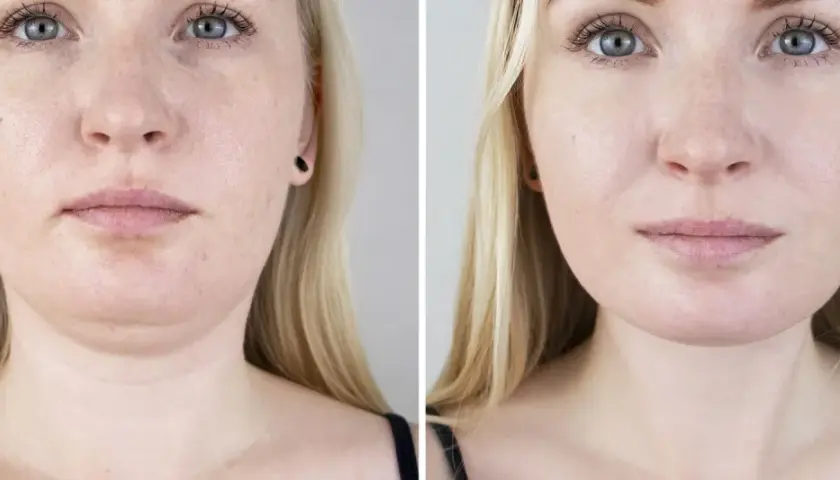 Före- och efterbilder visar resultat av fettfrysning för att minska dubbelhaka.