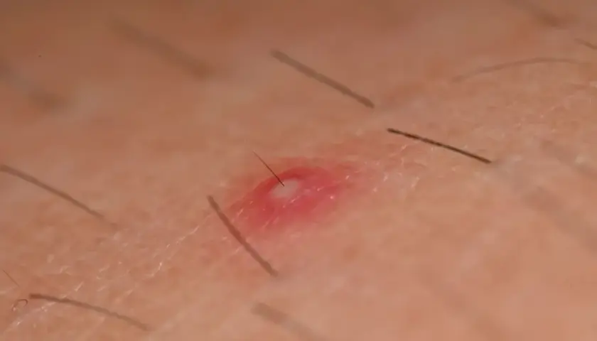 Bolesne krosty pod pachami? Zobacz domowe sposoby na ulgę i pozbycie się nieprzyjemnych zmian.