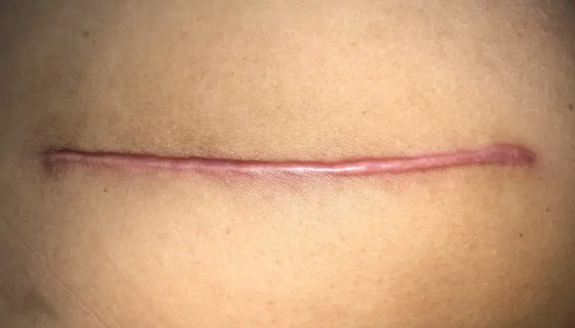 Gros plan d'une cicatrice sur la peau, légèrement rosée et bombée. Elle semble propre, sans signe de cicatrice qui suinte jaune.