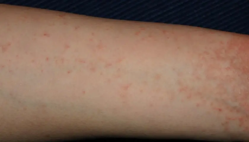 Braccio con eruzione cutanea rossa e pruriginosa, simile a una falsa scabbia.