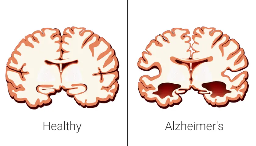 Choroba Alzheimera: neurologiczna czy psychiczna? Rozwiewam wątpliwości