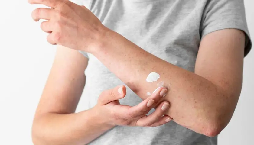 Persona aplica crema en su brazo, quizás para tratar hongos en la piel porque salen por humedad o contacto.