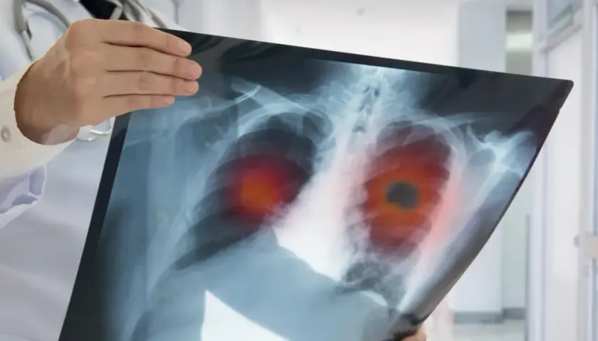 Die alarmierenden Symptome des Bronchialkarzinoms erkennen und verstehen