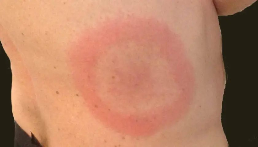 Rött, cirkulärt utslag på huden, liknande en rodnad. Kan vara ett tecken på utslag bebis allergi.