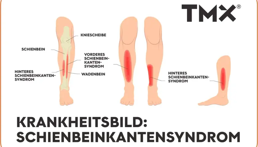 Illustration zeigt das Schienbeinkantensyndrom (shin splint) mit roten Schmerzbereichen am Schienbein und Wadenbein.