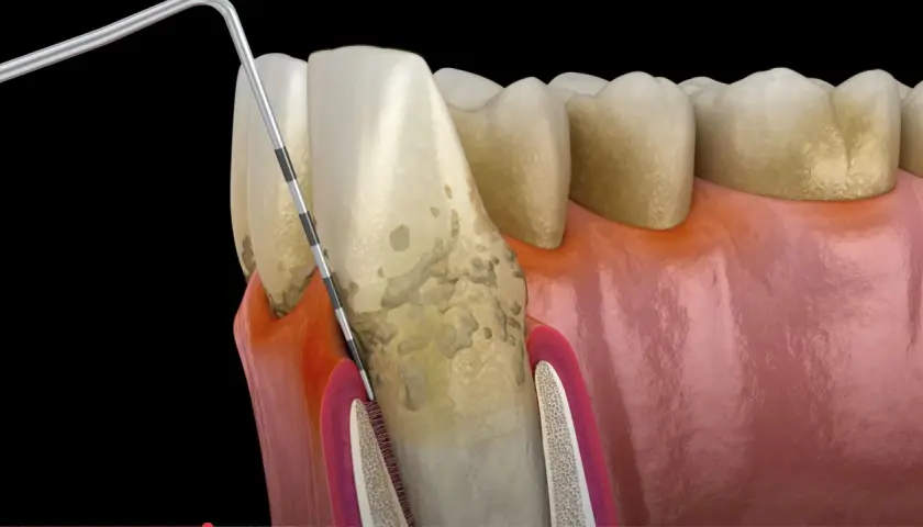 Model zęba z widocznymi oznakami chorób przyzębia. Narzędzie dentystyczne bada kieszonkę dziąsłową, ujawniając problemy, które mogą wskazywać na rzadkie choroby zębów.