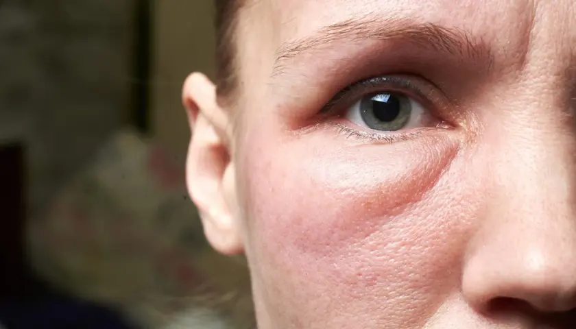 Gros plan sur le visage d'une femme, montrant un œil et une partie de son oreille. La peau sous l'œil est visiblement gonflée, un symptôme courant du visage gonflé pendant les règles.