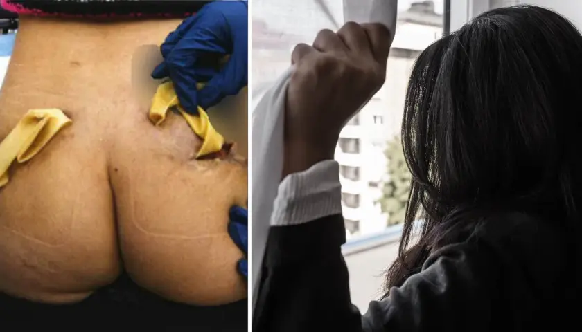Närbild på en rumpa med synliga ärr och gula kompresser, troligen efter fillers i rumpan. Bredvid en kvinna som tittar ut genom ett fönster.