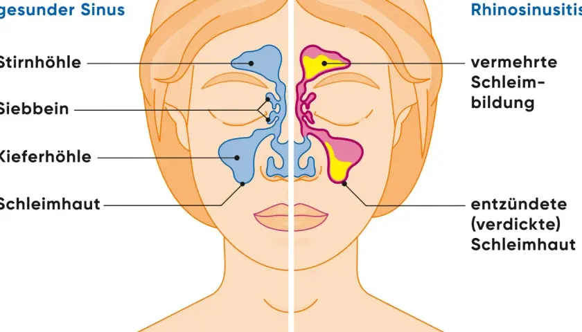 Vergleich gesunder Sinus und Rhinosinusitis: Entzündete Schleimhaut und vermehrte Schleimbildung sind typische nasennebenhöhlenentzündung symptome.