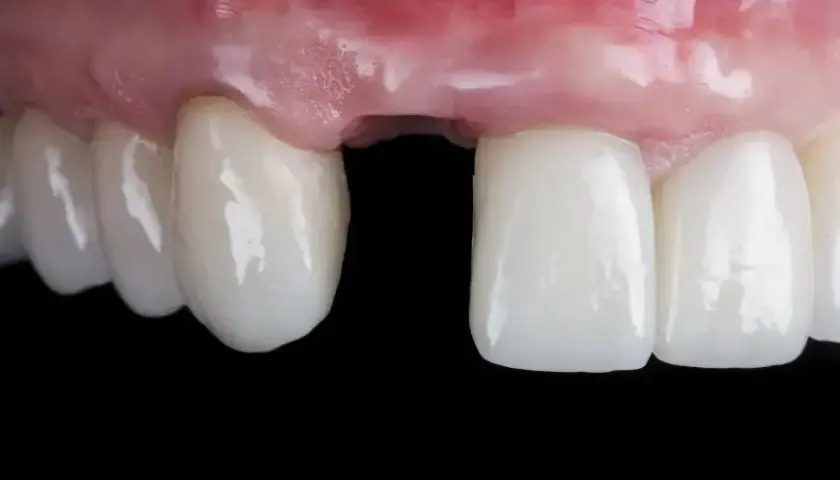 Krwawienie po wyrwaniu zęba: Ile trwa? Jak tamować? Kiedy do dentysty?