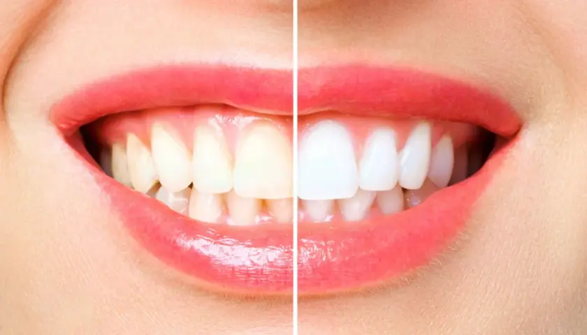 Sorriso diviso: a sinistra denti ingialliti, quasi senza smalto, a destra bianchissimi e splendenti.
