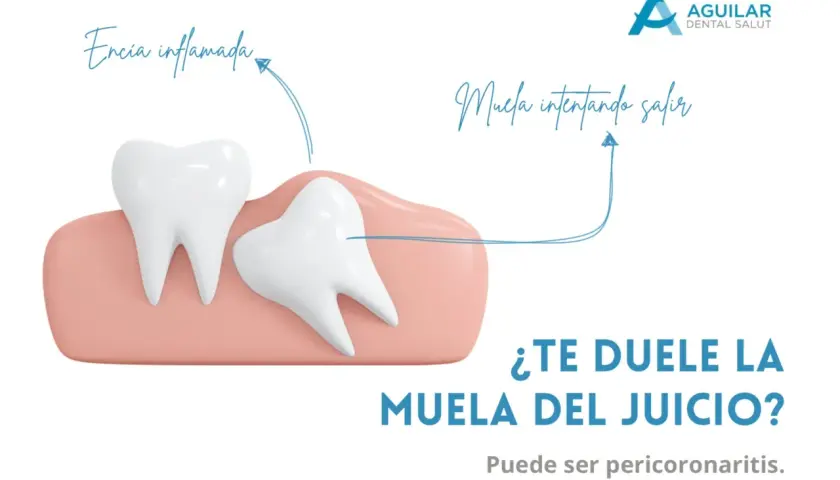 Ilustración de una muela del juicio impactada y encía inflamada, causando dolor de cabeza. Pregunta: ¿Te duele la muela del juicio?