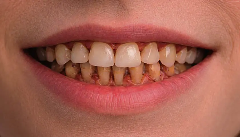 Boca con dientes amarillentos y encías inflamadas, mostrando signos de periodontitis crónica.