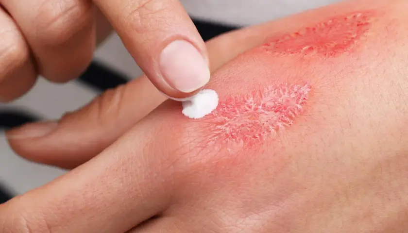 Application de crème sur une brûlure pour favoriser l'étape cicatrisation brûlure. La peau est rouge et irritée.